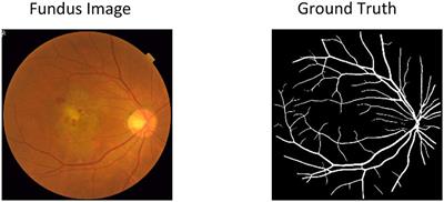 Deep learning based retinal vessel segmentation and hypertensive retinopathy quantification using heterogeneous features cross-attention neural network